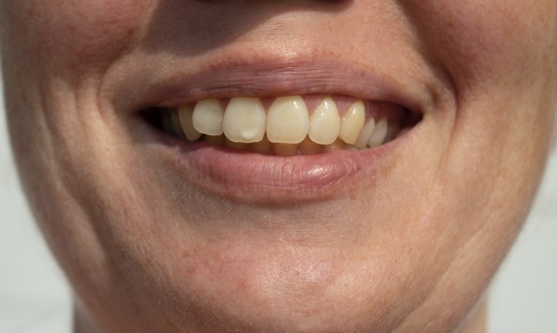 white spot on teeth